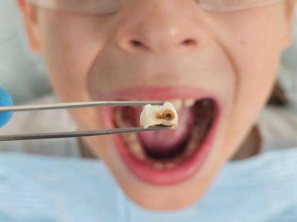 Best Pediatric Emergency Dentist in Temecula, CA